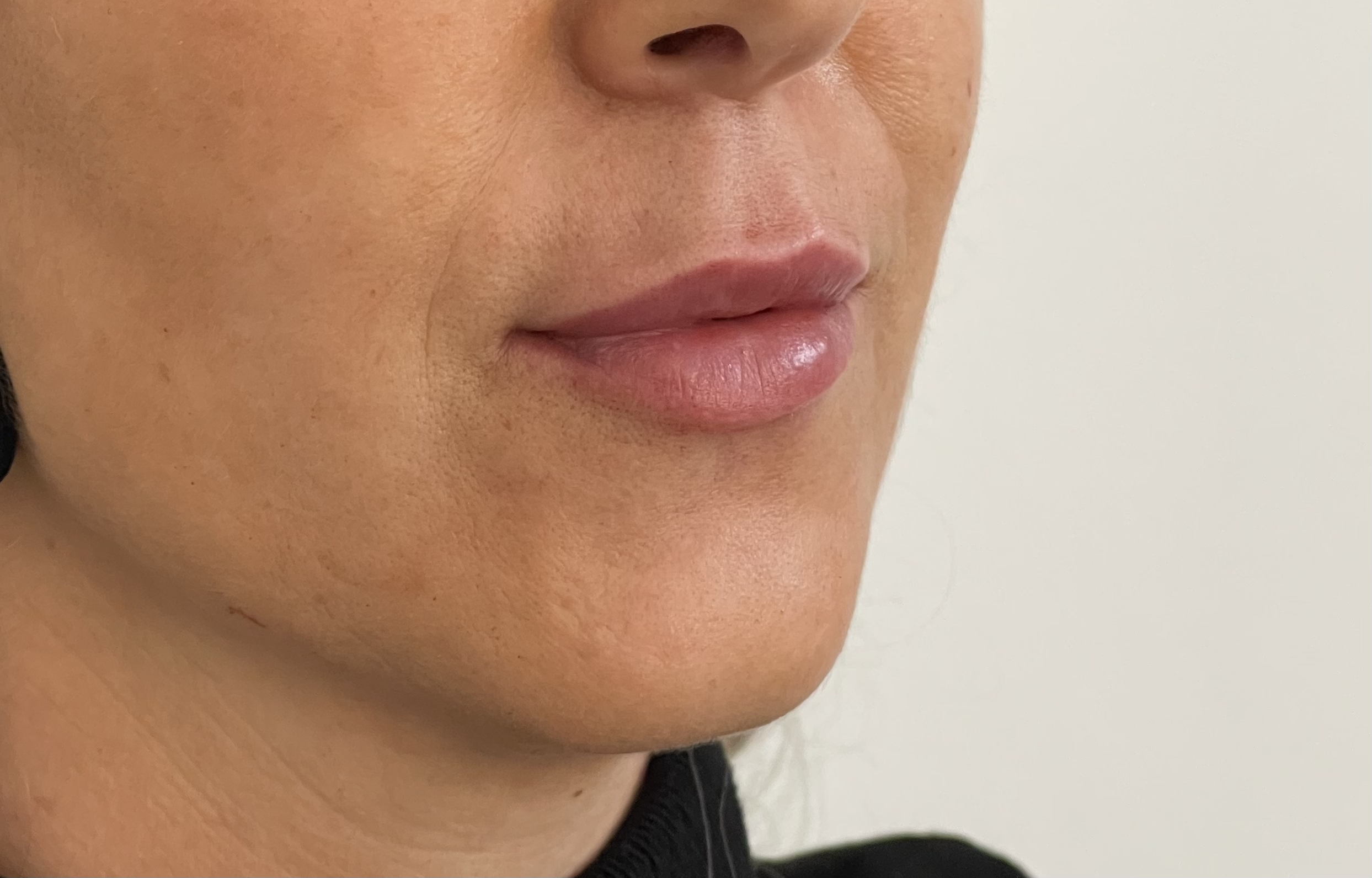 Preenchimento labial - Caso 2.3