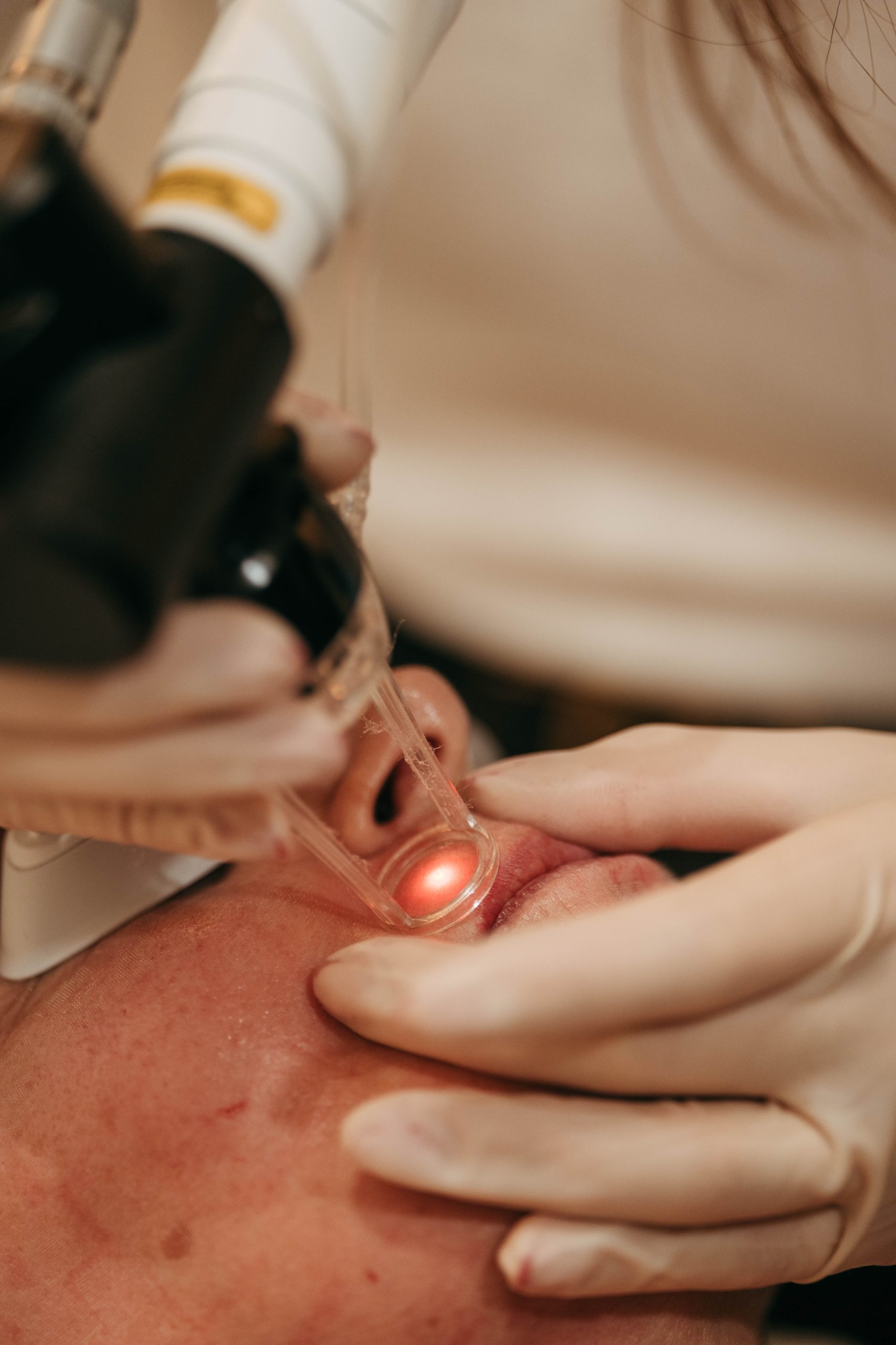 Aplicação de laser CO2 fracionado na zona à volta da boca, na MINIMAL Medical
