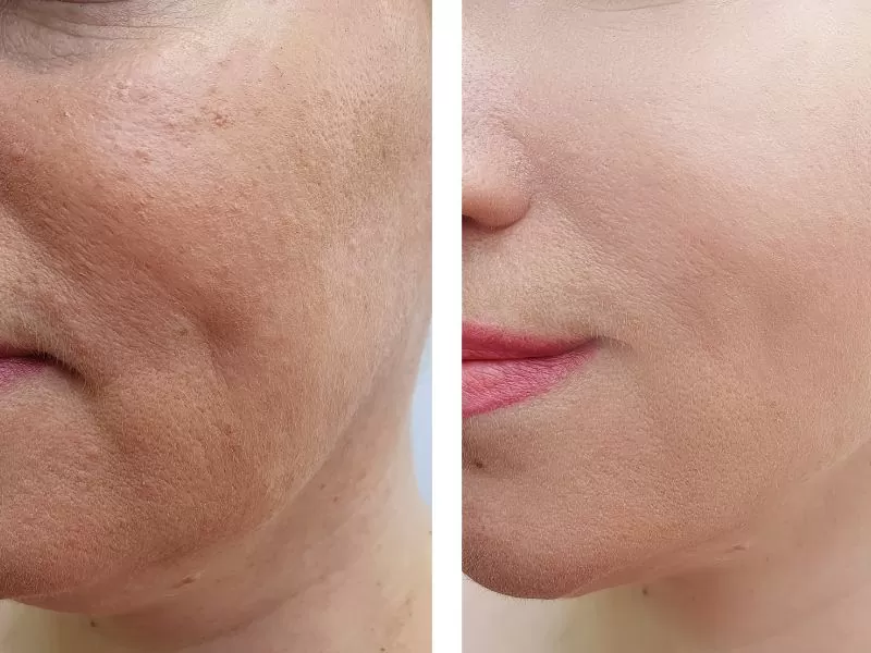 Antes e depois do tratamento duplo queixo
