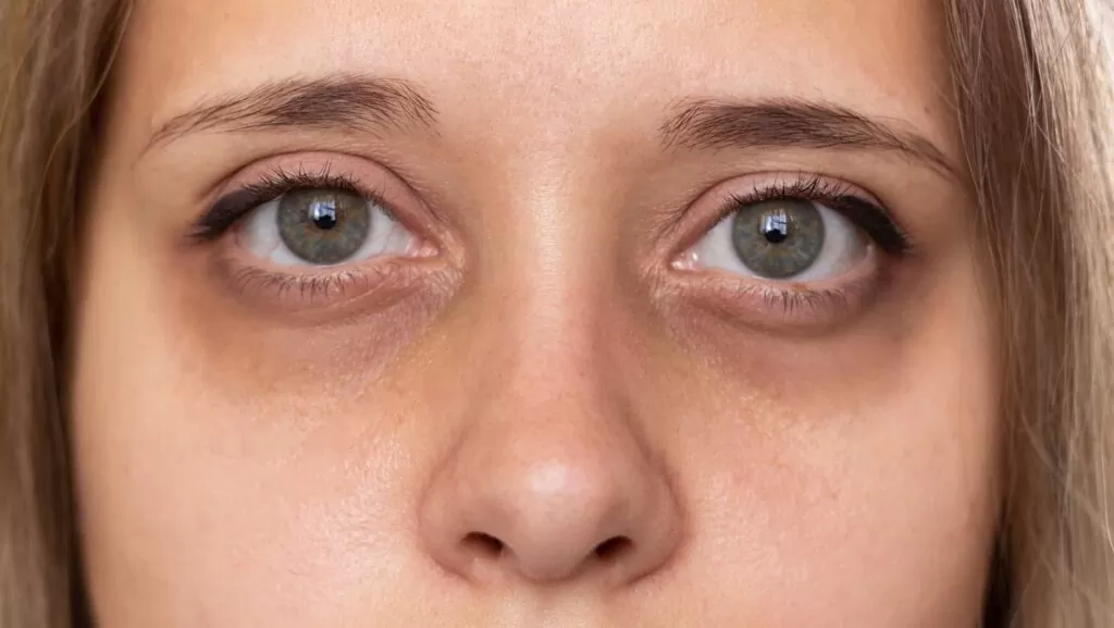 mulher com olheiras profundas