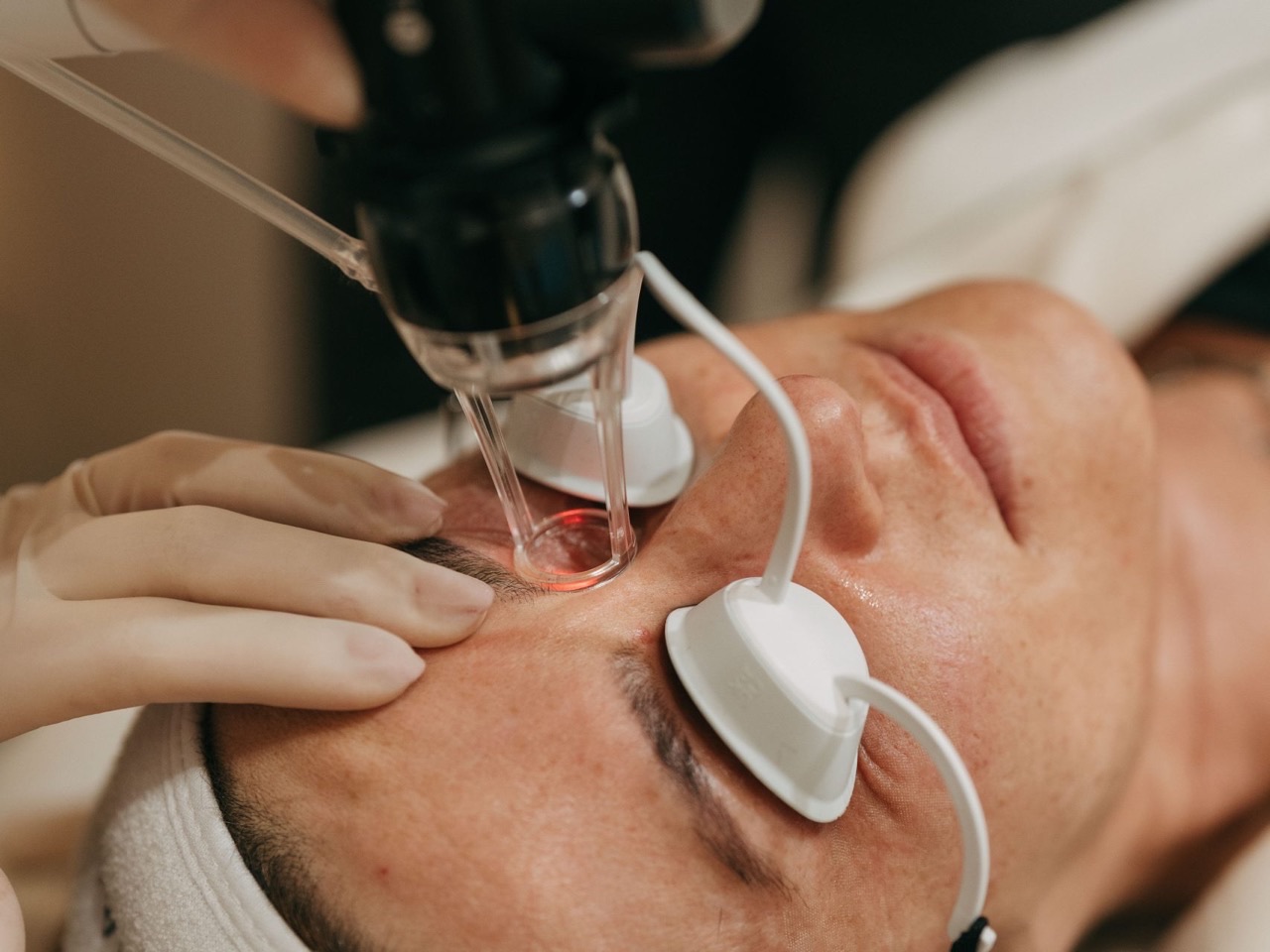 Tratamento com laser CO2 fracionado na MINIMAL Medical, com proteção ocular