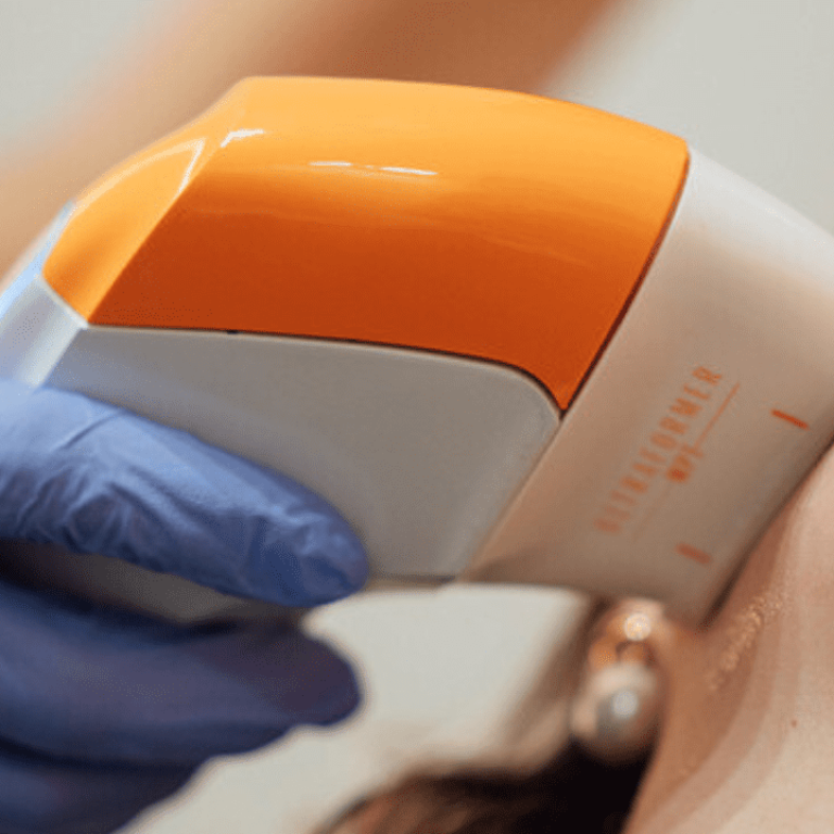 Paciente a fazer ultraformer mpt